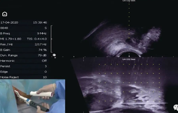 泌尿活检新突破---立普医疗低风险经会阴活检套件全球同步推出