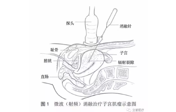 超声引导经皮微波（射频）消融治疗子宫肌瘤临床应用指南（2017版）